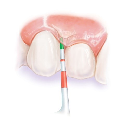 Periodontologas: kas sukelia periodonto ligas ir kaip jas gydyti?