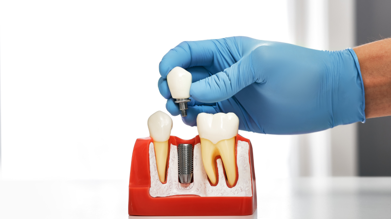 Dantų implantai – inovatyvus būdas atkurti šypsenos funkcionalumą. Pasakoja odontologas