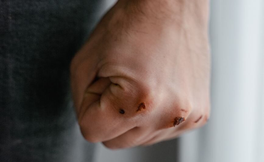 close up shot of wound on a person s hand